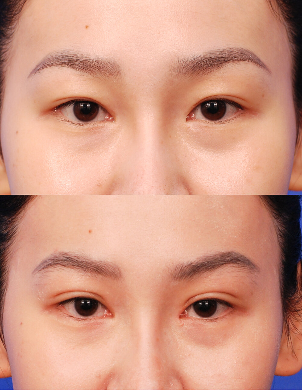 double-eyelid-surgery-inscore-kr